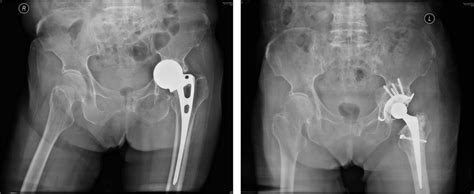 Austinemoore Prosthesis Protrusio With Acetabular American Academy Of