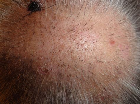 What Causes Bald Spots On Your Head Understanding The Condition The