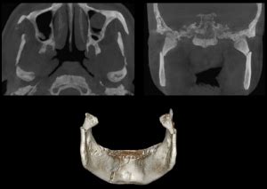 Caso N Fractura Mandibular Cdi Per