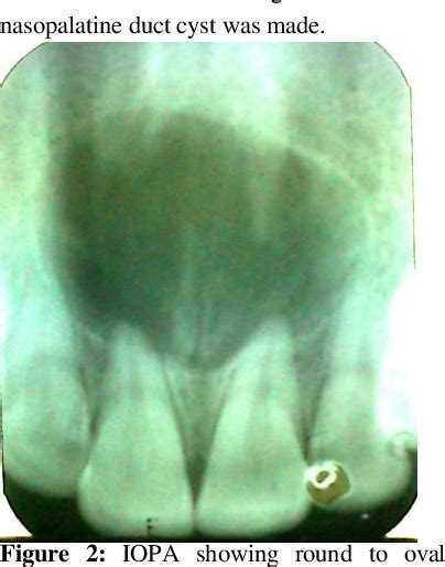 Figure 2 From Nasopalatine Duct Cyst A Case Report And Review Of