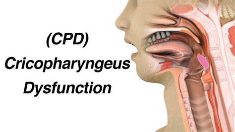 Cricopharyngeus Dysfunction (CPD) Causing Dysphagia or Trouble ...