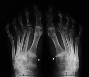 Radiographic Evaluation Of Arthritis Online Medical Library