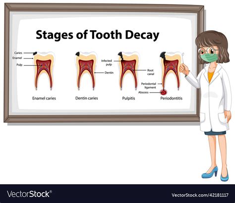 Infographic Of Human In The Stages Tooth Decay Vector Image