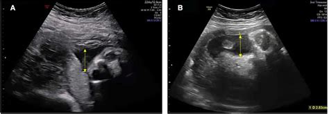 Ultrasound Showing A Reduced Volume Of Amniotic Fluid In The Mother