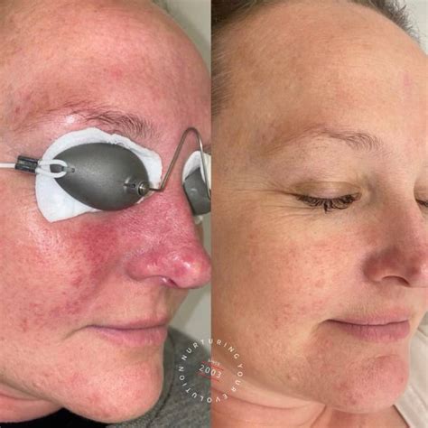 Treating Rosacea Laser Treatment For Rosacea Elc