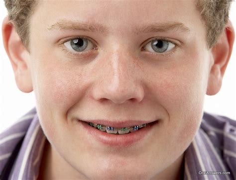 60 Photos of Teenagers with Braces | Oral Answers