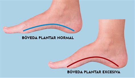 Pies Cavos Cu L Es El Mejor Tratamiento Ortopedia
