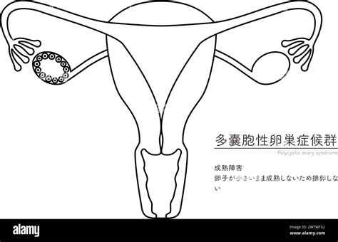 Diagrammatic Illustration Of Polycystic Ovary Syndrome Maturation