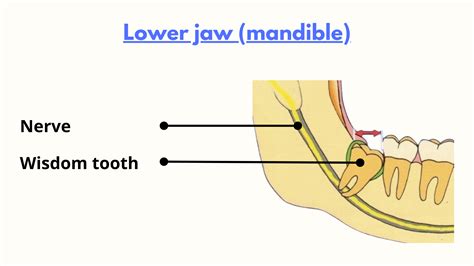 My Actual Risk of Nerve Damage After Wisdom Teeth Removal