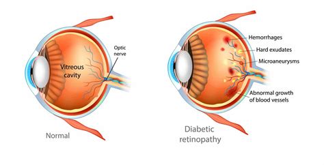 Diabetic Eye Exams Ophthalmologist Eye Doctor Dr James M