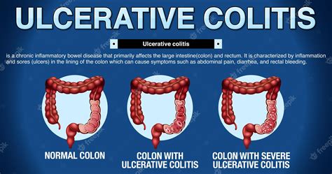 Infografía De Los Síntomas De La Colitis Ulcerosa Vector Gratis