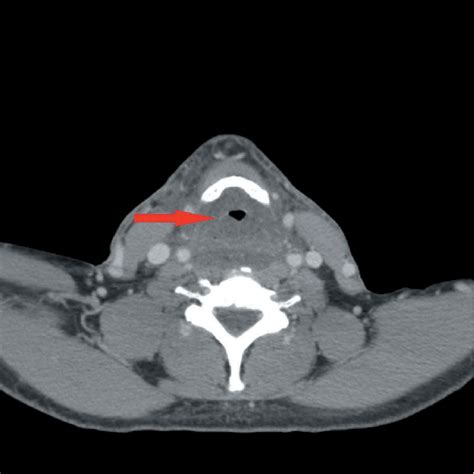 Axial Contrast Enhanced Ct Scan Of Neck Soft Tissue At The Level Of Download Scientific Diagram