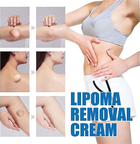 Pcs Lumpfree Lipoma Removal Cream Herbal Lipoma Lumps Removal Cream