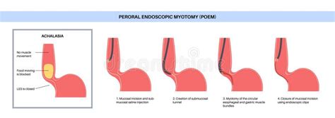 POEM medical poster stock vector. Illustration of endoscopic - 290866948