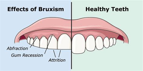 What Is Bruxism News Dentagama