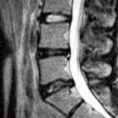 Degenerative Disc Disease – Clinical Tree