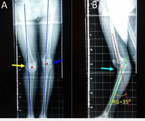 Standing Long Limb Radiograph Of The 15 Year Old Boy With Genu