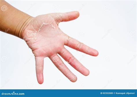 The Dry Hands Peel Contact Dermatitis Fungal Infections Skin Inf