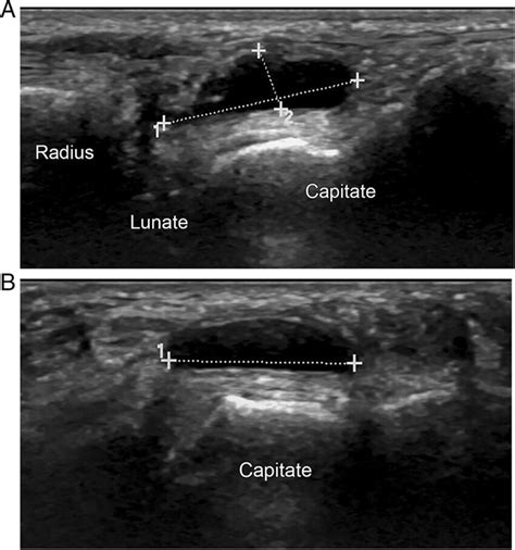 Ganglion Cyst Wrist Ultrasound