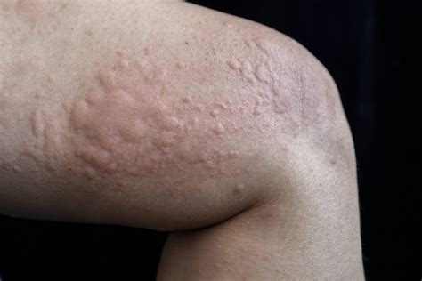 Hives Urticaria Causes Pictures Treatments And 53 Off