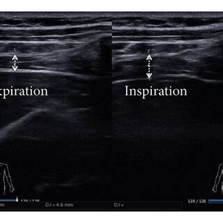 Sketch map of diaphragm measurement (a) Diaphragm thickness measurement ...