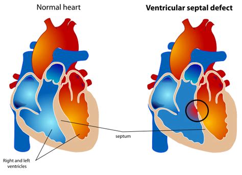 File Ventricular Septal Defect Svg Wikipedia