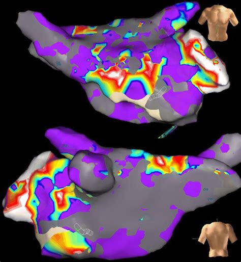 Electroanatomical Map Of The Left Atrium In AP And PA View Grey Areas