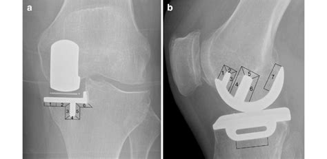 Looser Zones Radiology