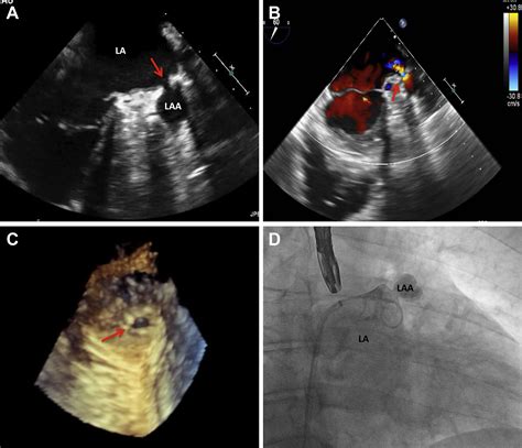 Percutaneous Closure Of A Residual Left Atrial Appendage Leak After