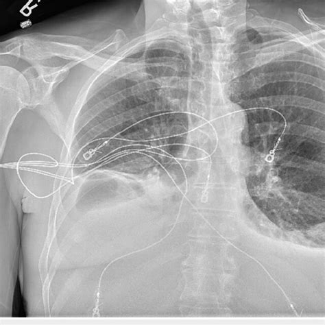 Chest X-ray with bibasilar consolidations with bilateral pleural... | Download Scientific Diagram