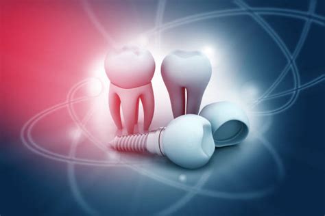 All About Dental Implant Protocols Royal Dental Clinics Blog