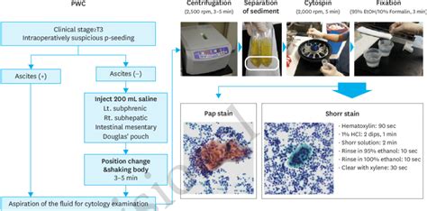 Schematic Of The Process Of Intraoperative Peritoneal Washing Cytology