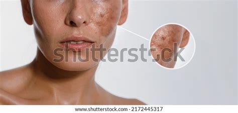 12 Hyper Pigmentation Makeup Images, Stock Photos & Vectors | Shutterstock