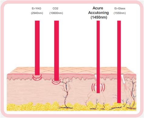 Apa Itu Acure Diode Nm Laser