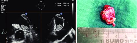 A Two Dimensional Transesophageal Echocardiography Image Modified