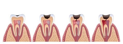 Theories of caries: description, causes, risk factors | Dentistry 2024