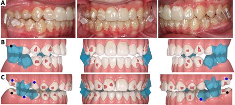 Clear Aligner Mandibular Advancement In Growing Patients With Class Ii Malocclusion Ajo Do