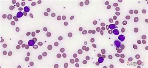 Mixed Phenotype Acute Leukaemia Learnhaem Haematology Made Simple