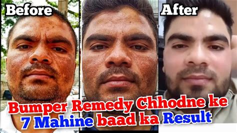 Bumper Remedy Chhodne Ke Mahine Baad Ka Result Pigmentation