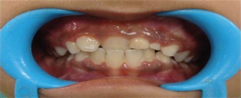 Dentigerous Cyst Containing Multiple Impacted Teeth A Rare