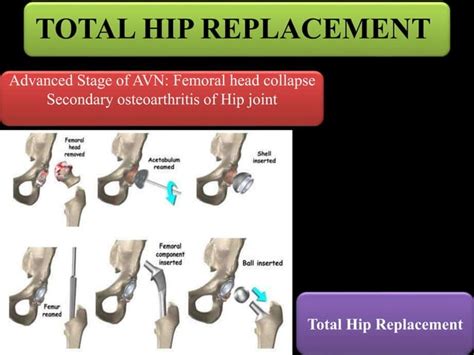 Avascular Necrosis Of Hip Avn Hip Ppt