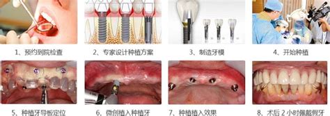 武汉哪些口腔机构可以做种植牙？种植牙全流程整理 知乎