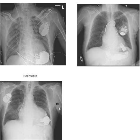 Schematic Illustration Of An Left Ventricular Assist Device Lvad With