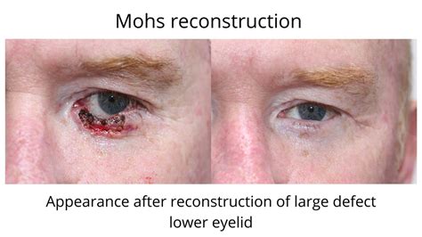 Skin Cancer Eyelid Mohs Procedure