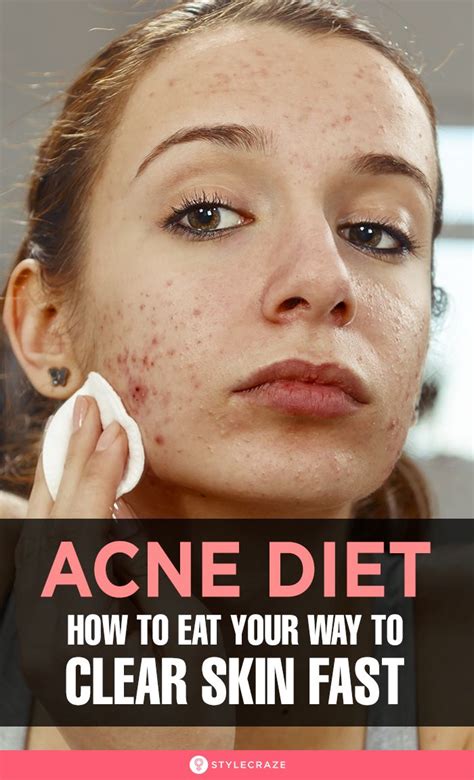 Anti Acne Diet What To Eat For Clearer And Healthier Skin Clear Skin