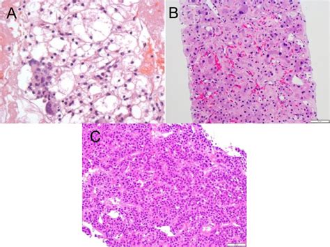 Primary Liver Cancers—part 1 Histopathology Differential Diagnoses And Risk Stratification Pmc