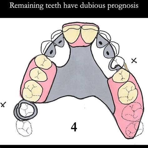 Universal Scandinavian partial denture designs | Finlay Sutton - Denture Education