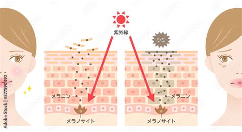 シミのしくみと紫外線 女性の肌の断面図 ビフォアアフター Stock ベクター Adobe Stock