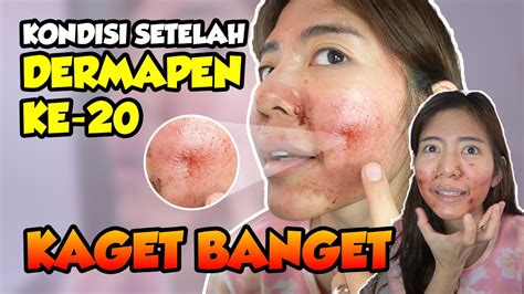 Review After Dermapen Hari Ke Hari Kok Jadi Gini Yaaa Youtube