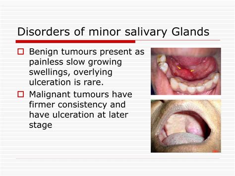 Ppt Salivary Glands Disorders Powerpoint Presentation Free Download